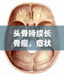 頭骨持續(xù)長(zhǎng)骨瘤，癥狀、成因與治療方案深度解析