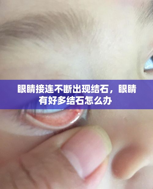 眼睛接連不斷出現(xiàn)結(jié)石，眼睛有好多結(jié)石怎么辦 