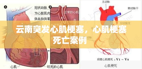 云南突發(fā)心肌梗塞，心肌梗塞死亡案例 