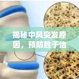 揭秘中風(fēng)突發(fā)原因，預(yù)防勝于治療！