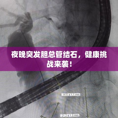 夜晚突發(fā)膽總管結(jié)石，健康挑戰(zhàn)來(lái)襲！